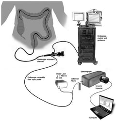Sensor Integrates IBD Detection into Colonoscopy Procedure