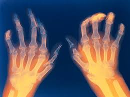 10 Breakthrough Rheumatoid Arthritis Therapies Set to Transform 2025
