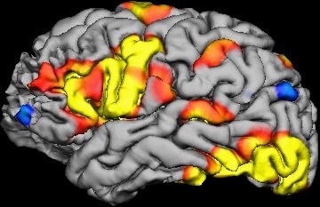 Swedish Study Calls Out Software Flaws in fMRI Results