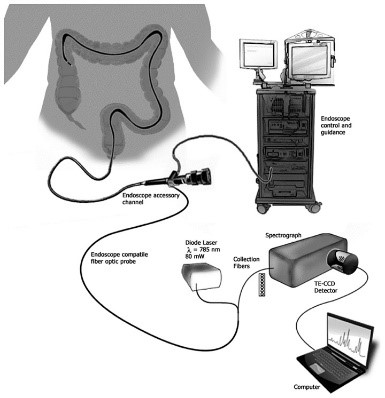 Sensor Integrates IBD Detection into Colonoscopy Procedure