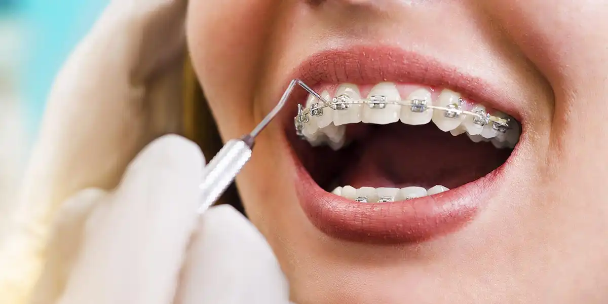 Orthodontics: FAQs Answered for Your Dental Health